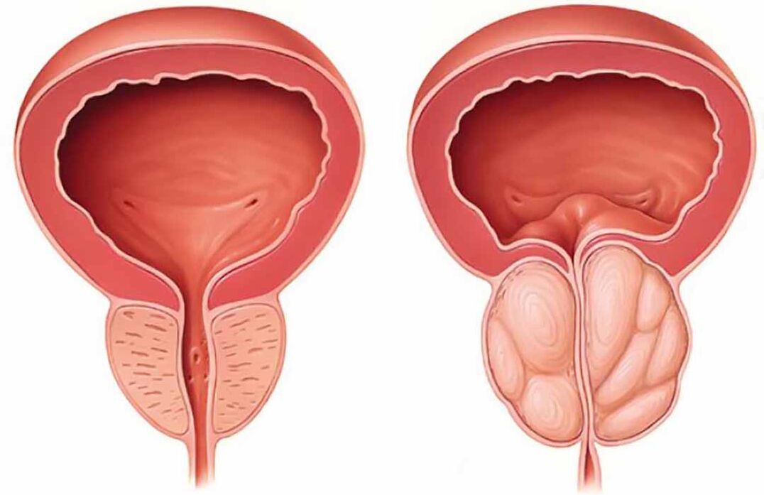 Normálna prostata a zápal prostaty (chronická prostatitída)