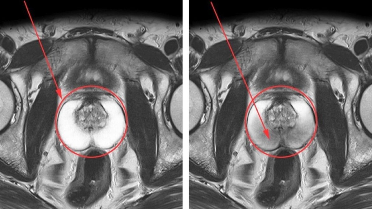 Ultrazvuk na chronickú prostatitídu – zdravá prostata (vľavo) a zapálená (vpravo)