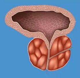 Charakteristické príznaky prostatitídy