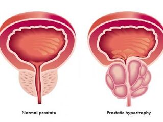 Normálna a zapálená prostata
