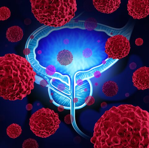 Príčinou vývoja prostatitídy je aktivita patogénnych mikroorganizmov